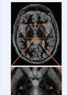 Conventional FGATIR MRI, axial, with zoomed inset failing to resolve GPi and lamina