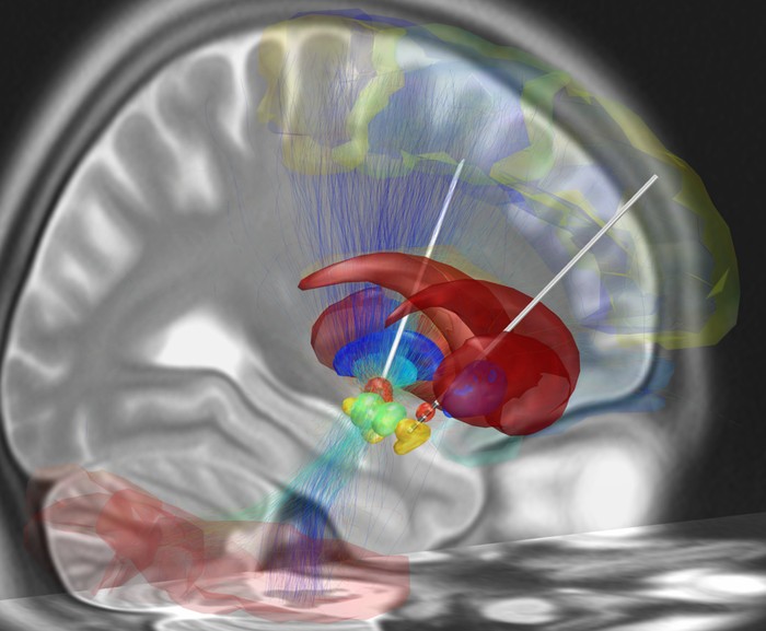 3D DBS surgical planning visualization showing subcortical structures, electrode trajectories, and white-matter tracts