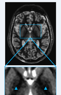 STAGE-FGATIR MRI, axial, with zoomed inset resolving GPi and lamina