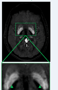 STAGE-QSM MRI, axial, with zoomed inset providing additional susceptibility information