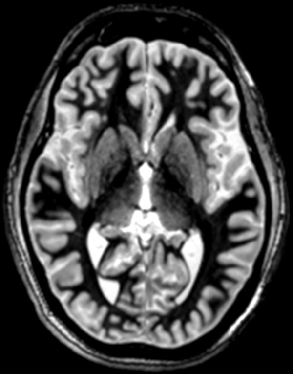 FGATIR axial image showing sharp gray/white matter contrast in deep brain structures