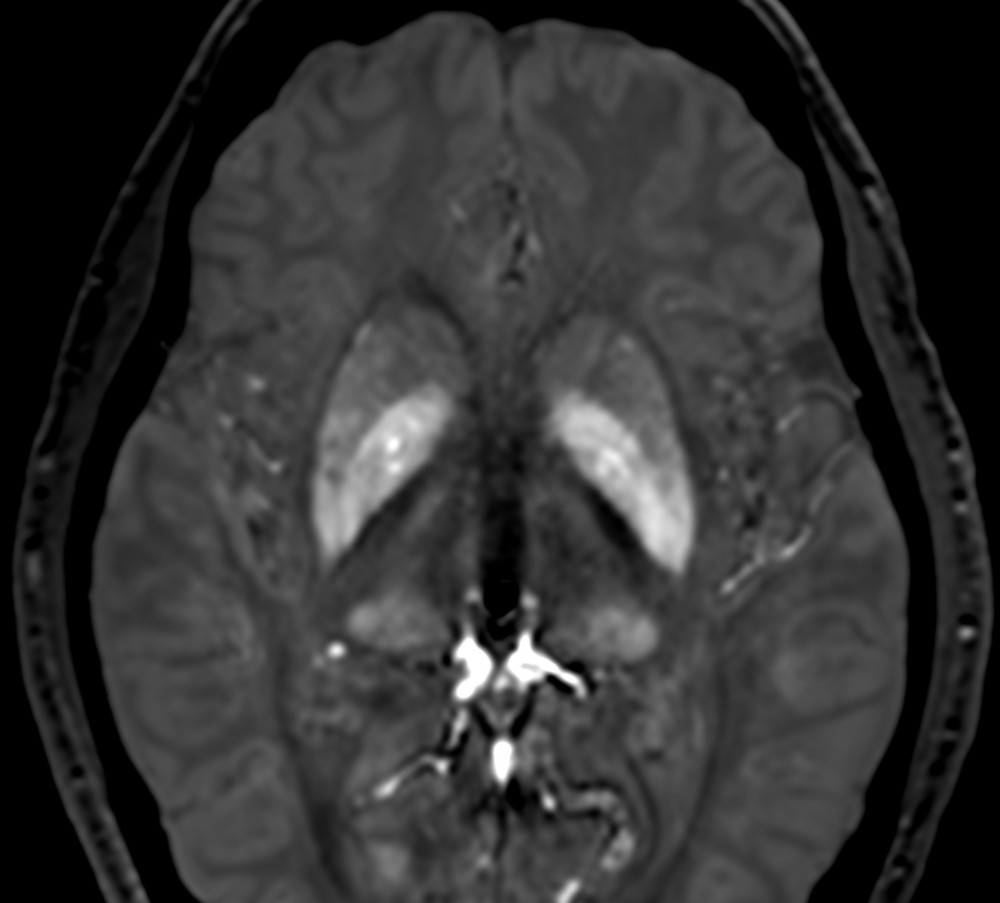 Axial brain MRI, susceptibility-weighted contrast through the basal ganglia