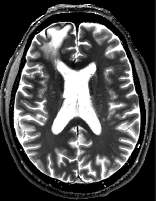Axial brain MRI showing gray/white matter and ventricular anatomy